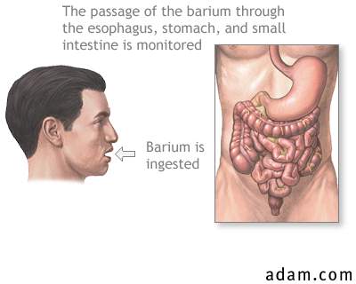 Barium ingestion