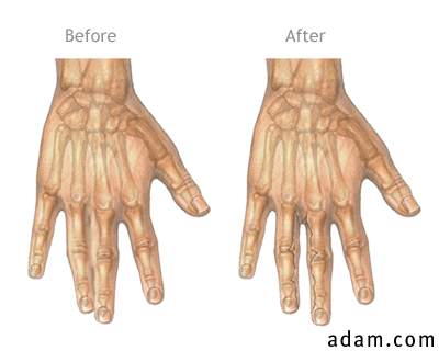 Before and after webbed finger repair