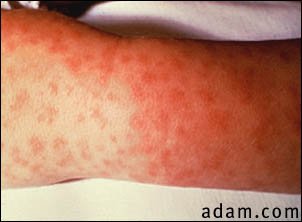 Rocky mountain spotted fever, lesions on arm