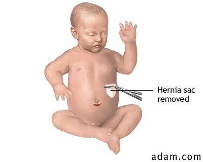 Procedure, Umbilical hernia repair