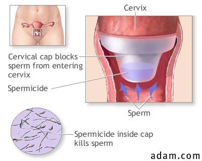 Cervical cap barrier