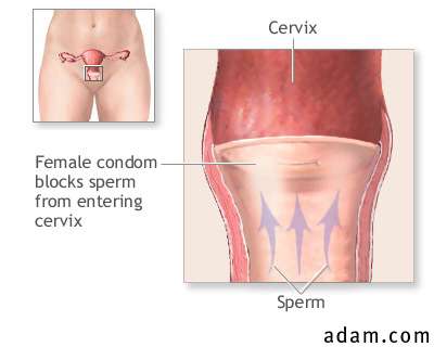 Female condom barrier