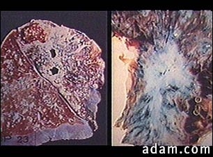 Tuberculosis in the lung