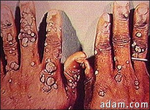 Warts, multiple - on hands