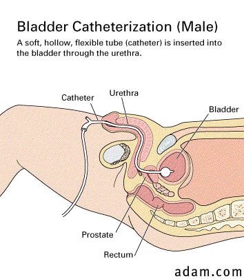 Bladder catheterization, male