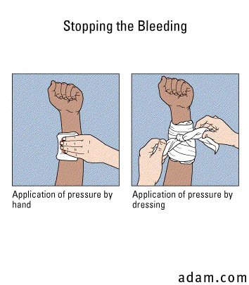Bleeding, stopping with direct pressure