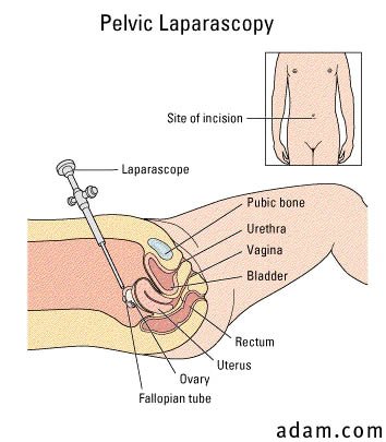 Pelvic laparoscopy