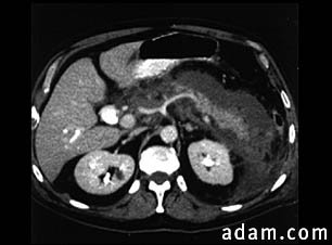 Pancreatitis, acute - CT scan
