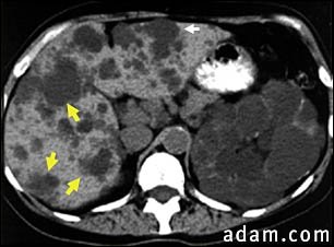 Kidney and liver cysts - CT scan