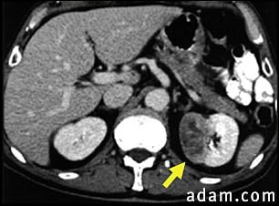 Kidney tumor - CT scan