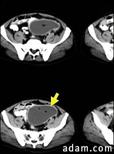 Intra-abdominal abscess, CT scan