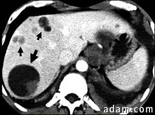 Liver echinococcus - CT scan