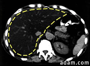 Liver fattening, CT scan