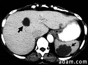Liver and spleen cysts - CT scan
