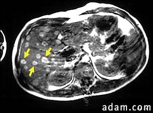 Melanoma of the liver - CT scan