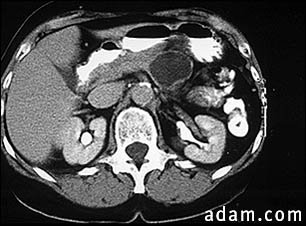 Pancreatic, cystic adenoma - CT scan