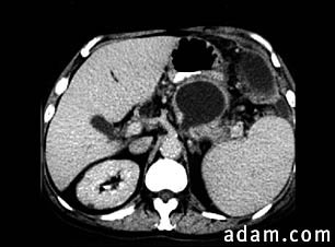 Pancreatic pseudocyst, CT scan