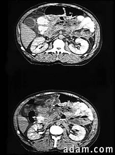 Pancreatitis, CT scan series