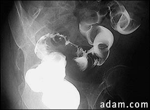 Sigmoid colon cancer, X-ray