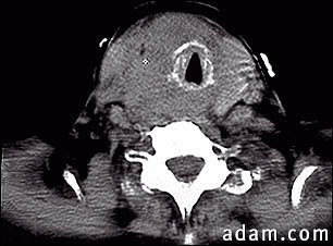 Thyroid cancer - CT scan