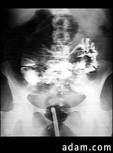 Volvulus - X-ray