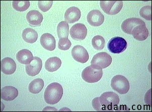 Megaloblastic anemia - view of red blood cells