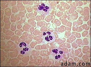 Polycythemia - red blood cells