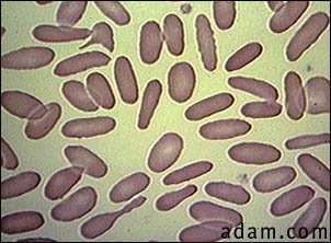 Red blood cells, eliptocytosis
