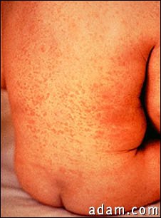Rubella on an infant's back