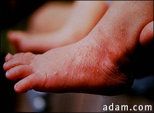 Erythema toxicum on the foot