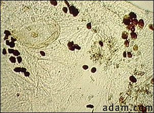 Scabies mite, photomicrograph of the stool