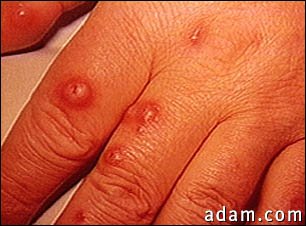 Cryptococcus, cutaneous on the hand