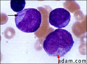 Acute myelocytic leukemia - microscopic view