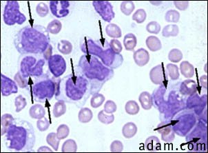 Acute myelomonocytic leukemia - microscopic view