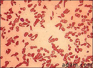 Red blood cells, sickle cells