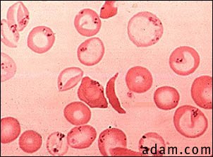 Red blood cells, sickle and pappenheimer