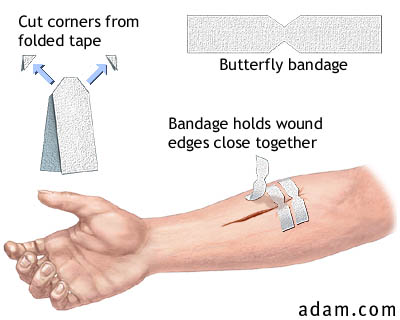 Butterfly Bandage