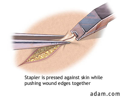 Stapling a Wound Closed