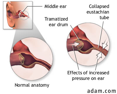 Middle Ear Squeeze