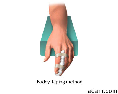 Buddy-Taping of Fingers (with Cushion)