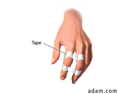 Buddy-Taping of Fingers (without Cushion)