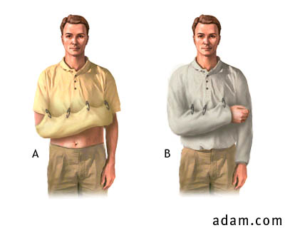 Shoulder/Arm Stabilization