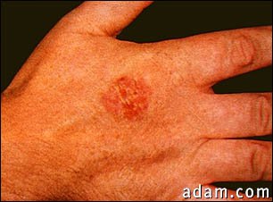 Bowen's disease on the hand