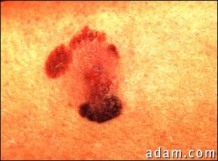 Skin cancer, malignant lentigo melanoma-close-up
