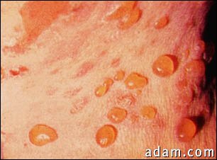 Bullous pemphigoid, close-up of tense blisters