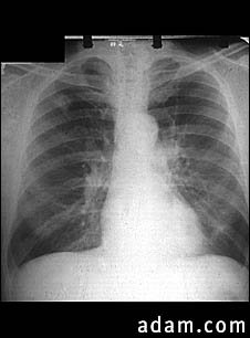 Adenocarcinoma - chest X-ray