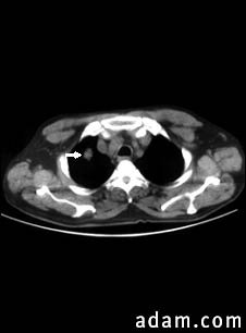 Pulmonary nodule, solitary - CT scan