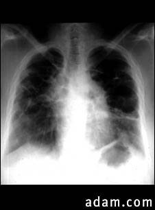 Sarcoid, stage IV - chest X-ray