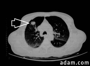 Lung mass, right upper lobe - CT scan