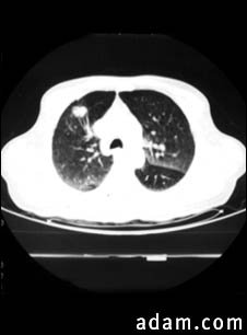Bronchial cancer - CT scan